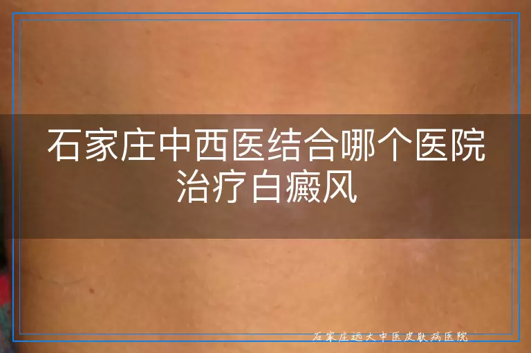 石家庄中西医结合哪个医院治疗白癜风