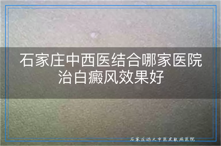 石家庄中西医结合哪家医院治白癜风效果好