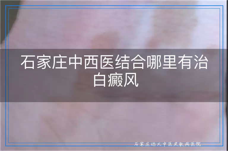 石家庄中西医结合哪里有治白癜风