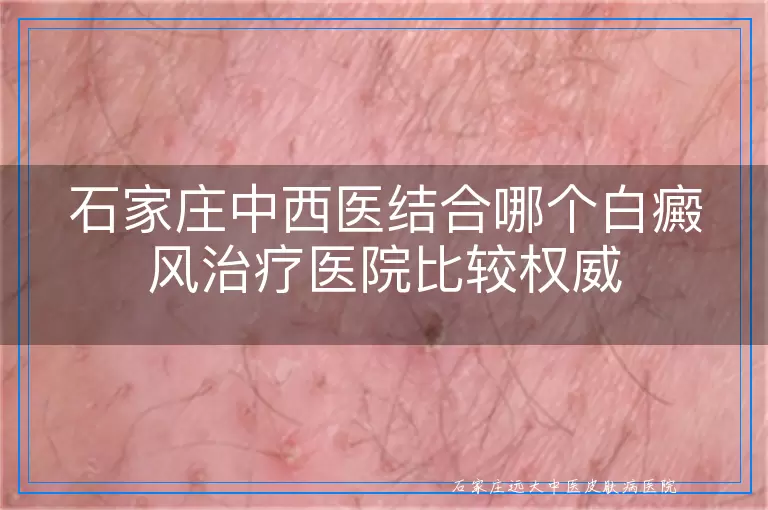 石家庄中西医结合哪个白癜风治疗医院比较权威