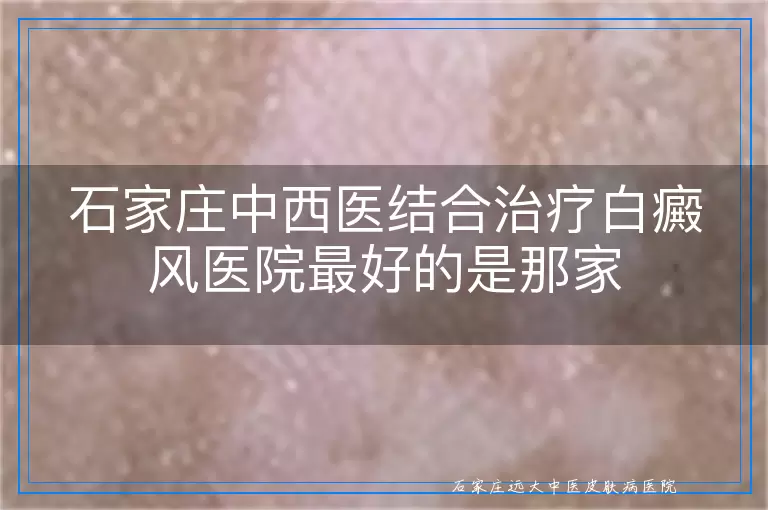 石家庄中西医结合治疗白癜风医院最好的是那家