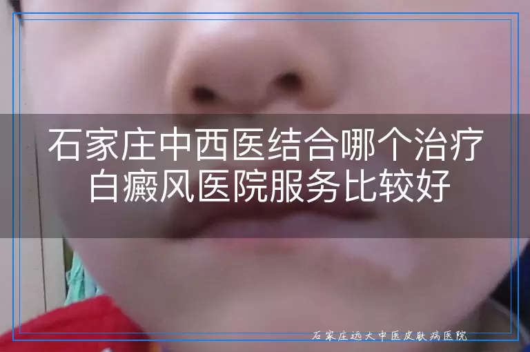 石家庄中西医结合哪个治疗白癜风医院服务比较好