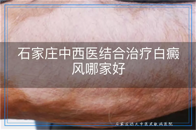 石家庄中西医结合治疗白癜风哪家好