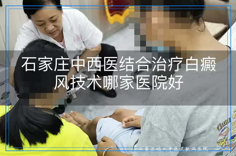 石家庄中西医结合治疗白癜风技术哪家医院好