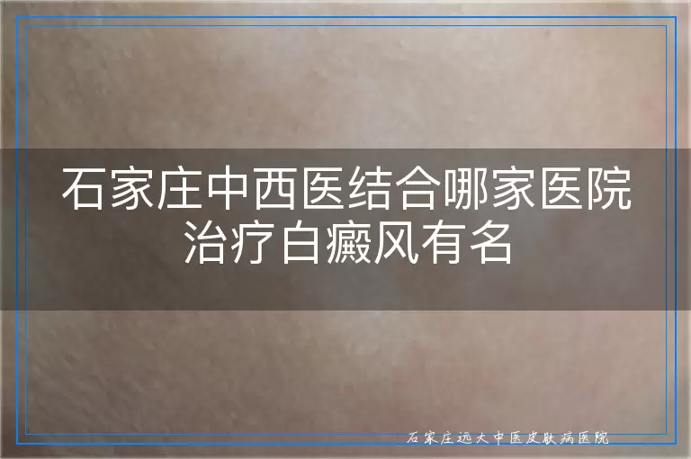 石家庄中西医结合哪家医院治疗白癜风有名