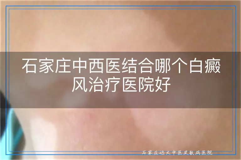 石家庄中西医结合哪个白癜风治疗医院好