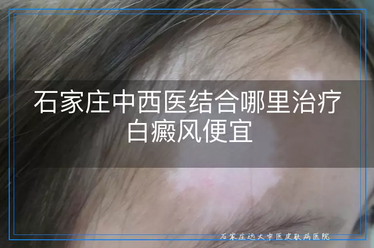 石家庄中西医结合哪里治疗白癜风便宜