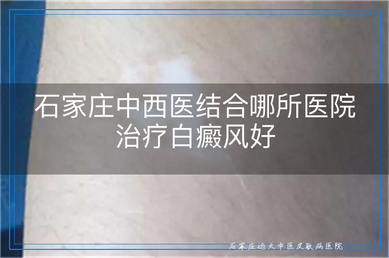 石家庄中西医结合哪所医院治疗白癜风好