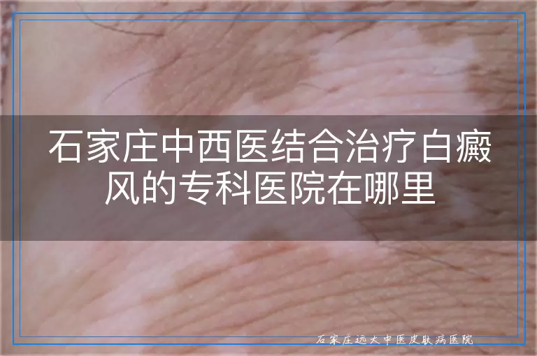 石家庄中西医结合治疗白癜风的专科医院在哪里
