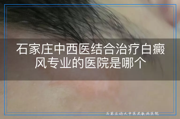 石家庄中西医结合治疗白癜风专业的医院是哪个