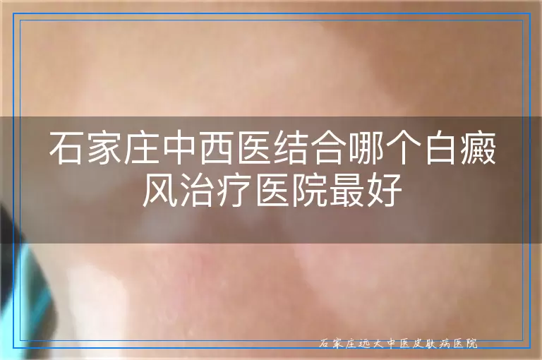 石家庄中西医结合哪个白癜风治疗医院最好