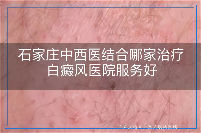 石家庄中西医结合哪家治疗白癜风医院服务好