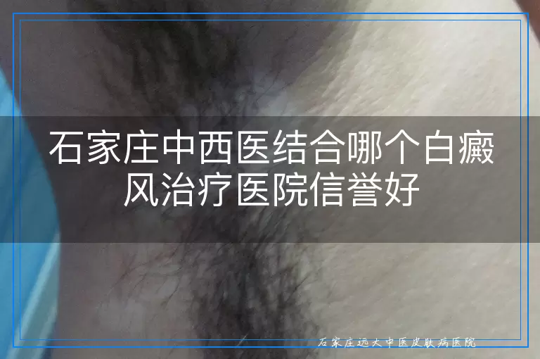 石家庄中西医结合哪个白癜风治疗医院信誉好