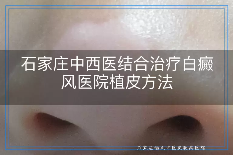 石家庄中西医结合治疗白癜风医院植皮方法