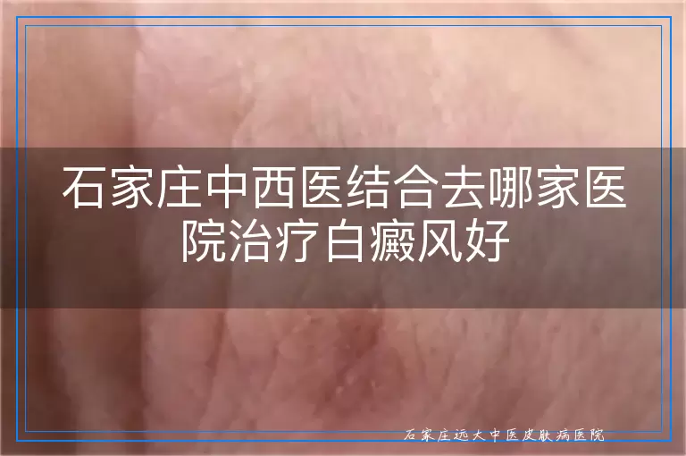 石家庄中西医结合去哪家医院治疗白癜风好
