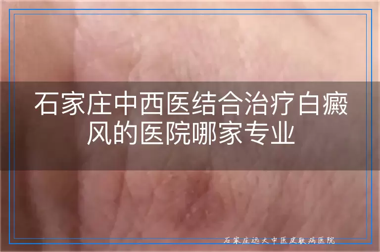石家庄中西医结合治疗白癜风的医院哪家专业