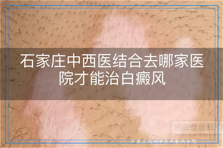 石家庄中西医结合去哪家医院才能治白癜风
