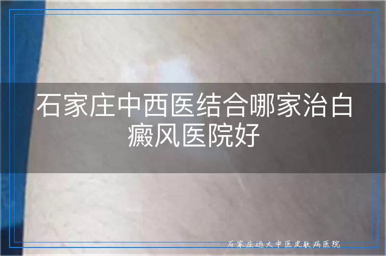 石家庄中西医结合哪家治白癜风医院好