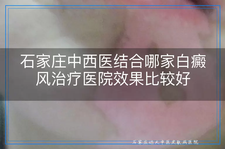 石家庄中西医结合哪家白癜风治疗医院效果比较好