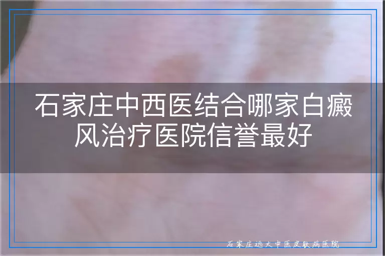 石家庄中西医结合哪家白癜风治疗医院信誉最好