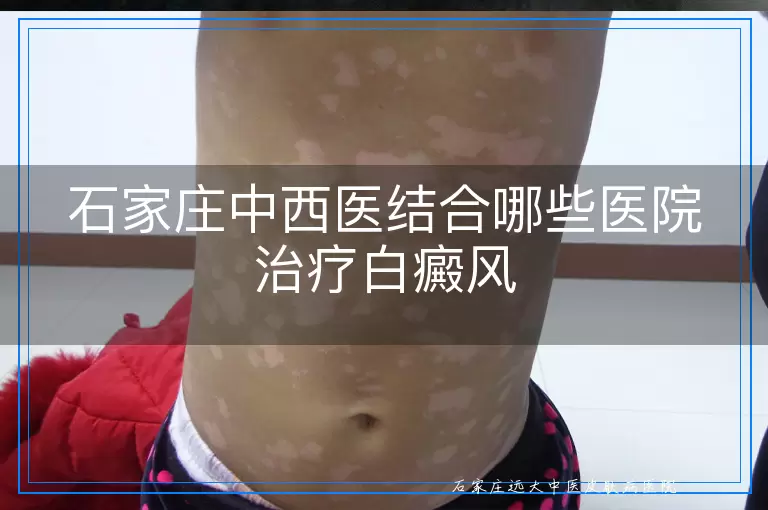 石家庄中西医结合哪些医院治疗白癜风