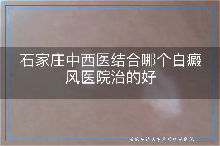 石家庄中西医结合哪个白癜风医院治的好