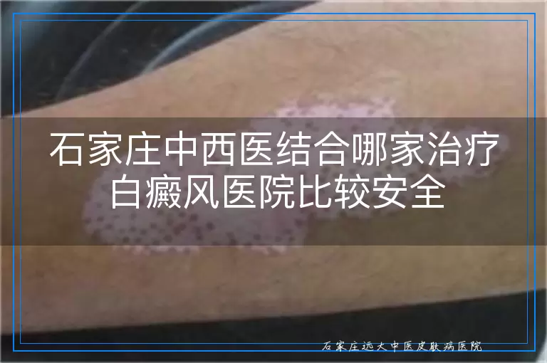 石家庄中西医结合哪家治疗白癜风医院比较安全