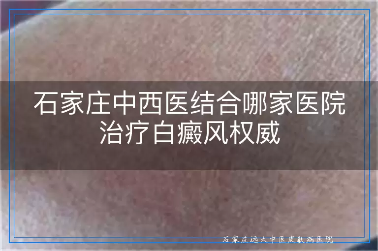 石家庄中西医结合哪家医院治疗白癜风权威