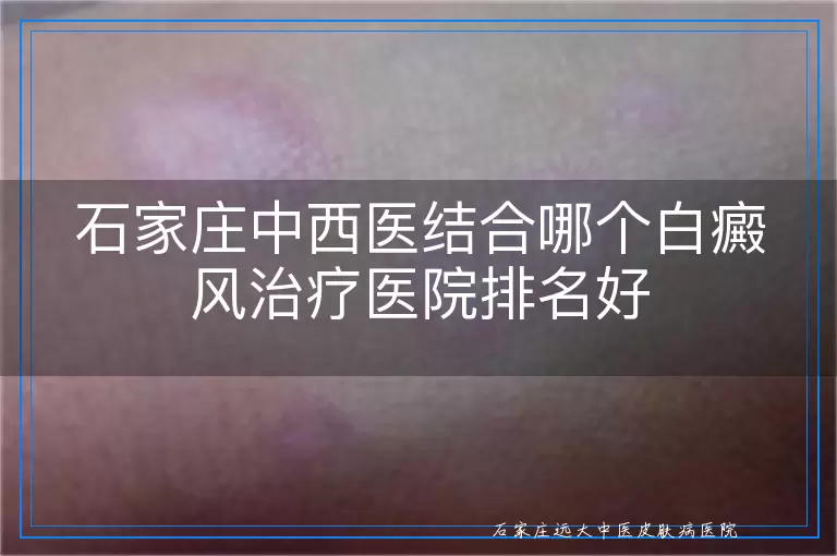 石家庄中西医结合哪个白癜风治疗医院排名好