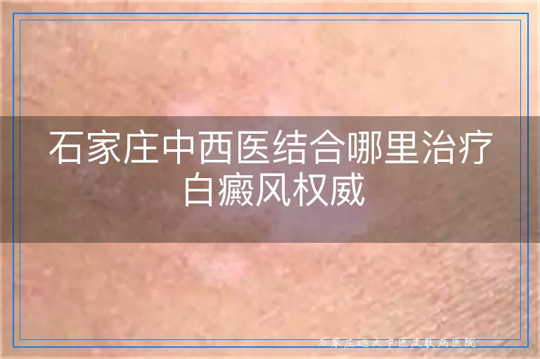 石家庄中西医结合哪里治疗白癜风权威
