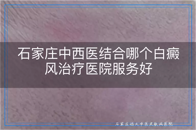 石家庄中西医结合哪个白癜风治疗医院服务好
