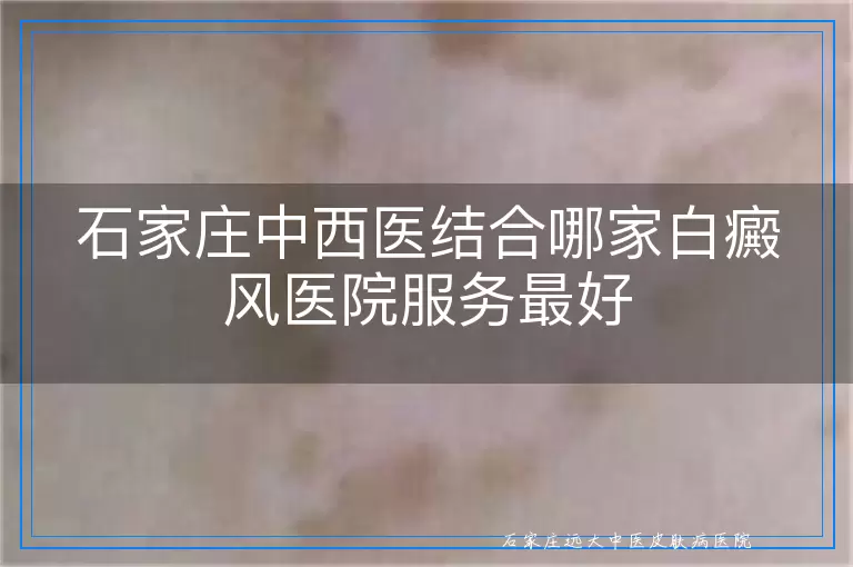 石家庄中西医结合哪家白癜风医院服务最好