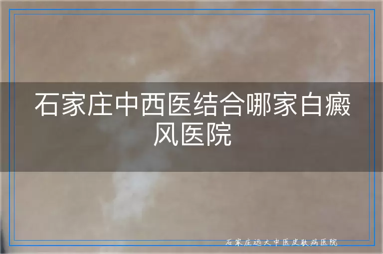 石家庄中西医结合哪家白癜风医院