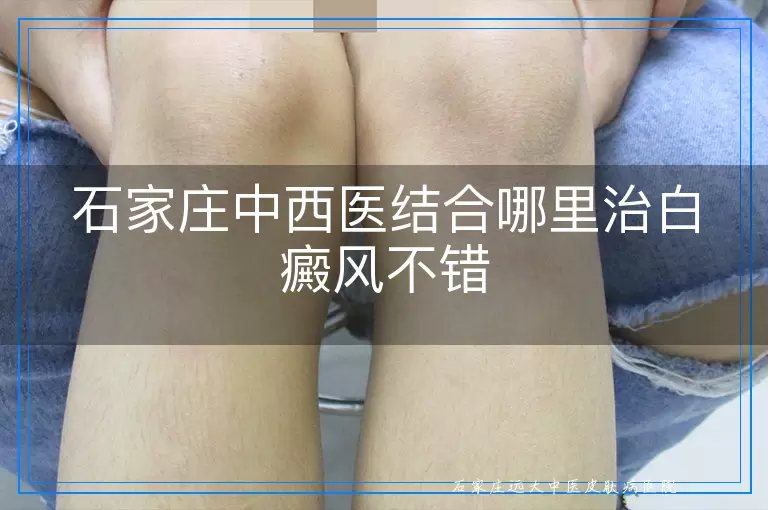 石家庄中西医结合哪里治白癜风不错