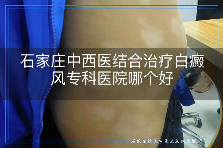 石家庄中西医结合治疗白癜风专科医院哪个好