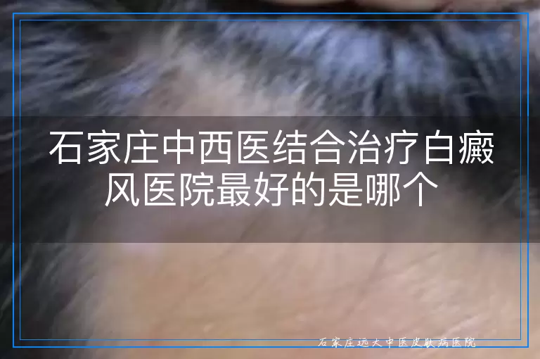 石家庄中西医结合治疗白癜风医院最好的是哪个