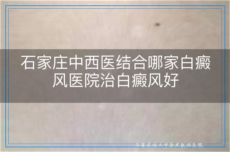 石家庄中西医结合哪家白癜风医院治白癜风好
