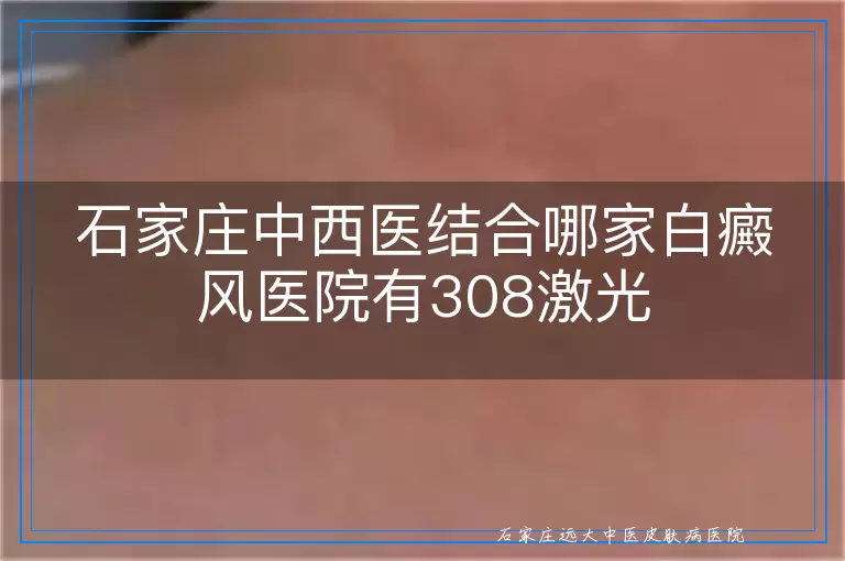石家庄中西医结合哪家白癜风医院有308激光