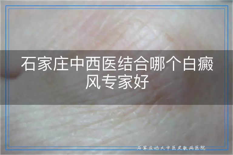 石家庄中西医结合哪个白癜风专家好
