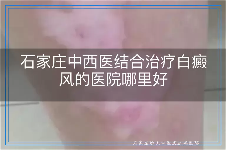 石家庄中西医结合治疗白癜风的医院哪里好