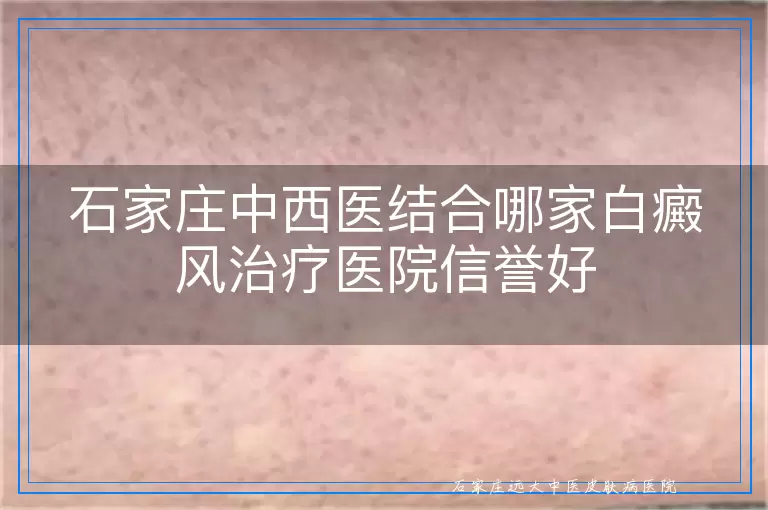石家庄中西医结合哪家白癜风治疗医院信誉好