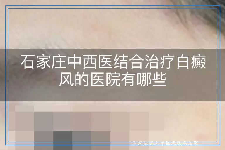 石家庄中西医结合治疗白癜风的医院有哪些
