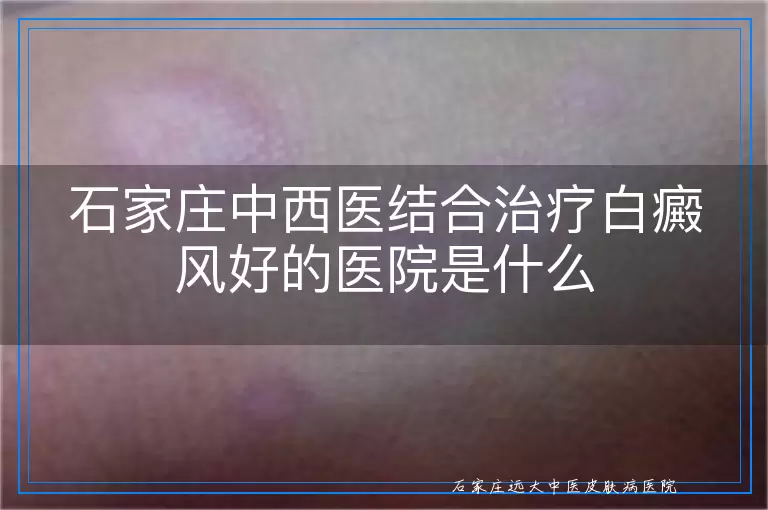 石家庄中西医结合治疗白癜风好的医院是什么