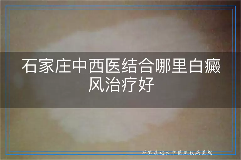 石家庄中西医结合哪里白癜风治疗好