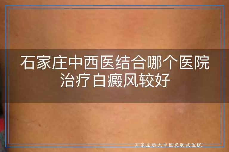 石家庄中西医结合哪个医院治疗白癜风较好