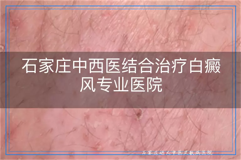 石家庄中西医结合治疗白癜风专业医院