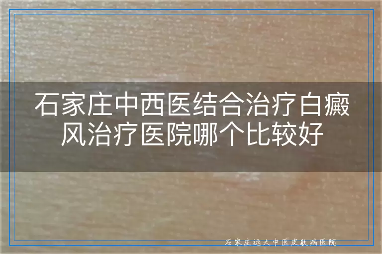 石家庄中西医结合治疗白癜风治疗医院哪个比较好