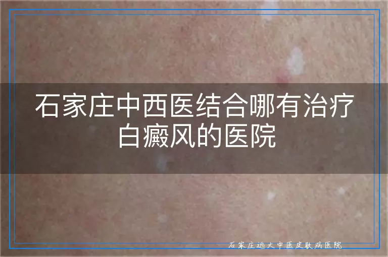 石家庄中西医结合哪有治疗白癜风的医院