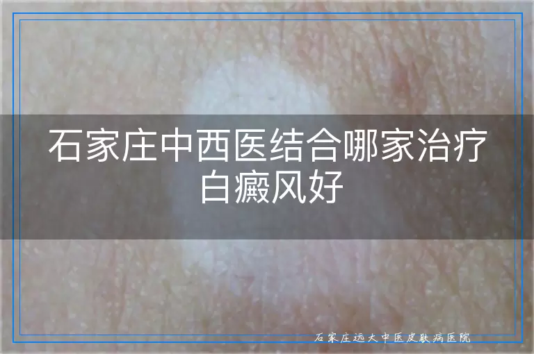 石家庄中西医结合哪家治疗白癜风好