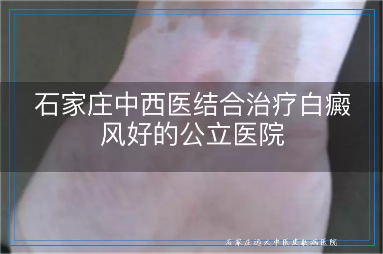 石家庄中西医结合治疗白癜风好的公立医院